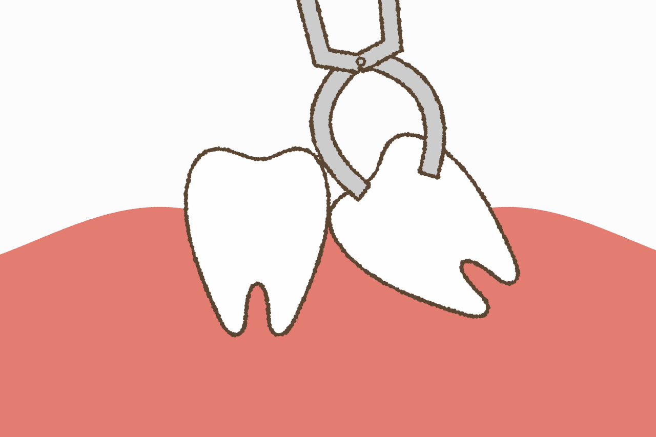 親知らずの抜歯の痛みについて