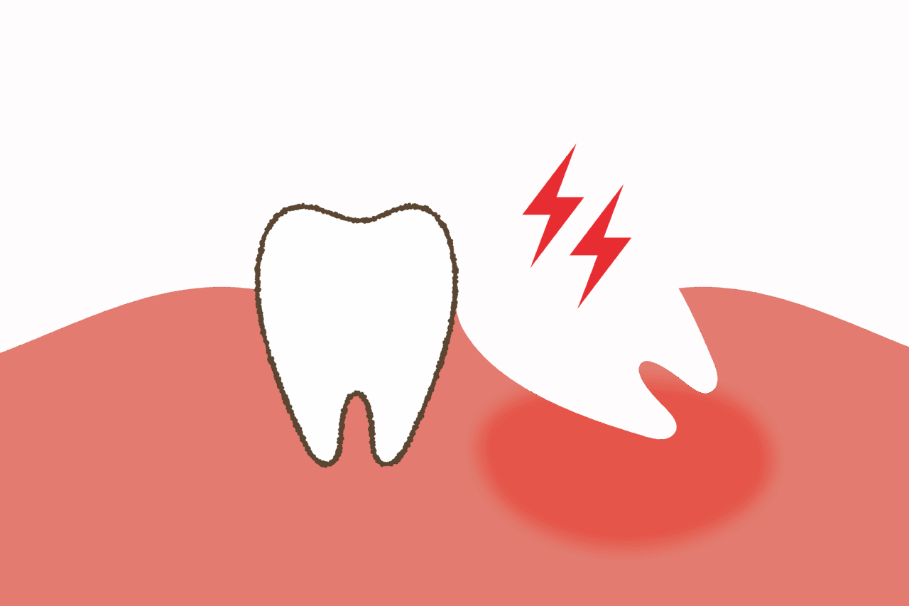 親知らずの抜歯後について