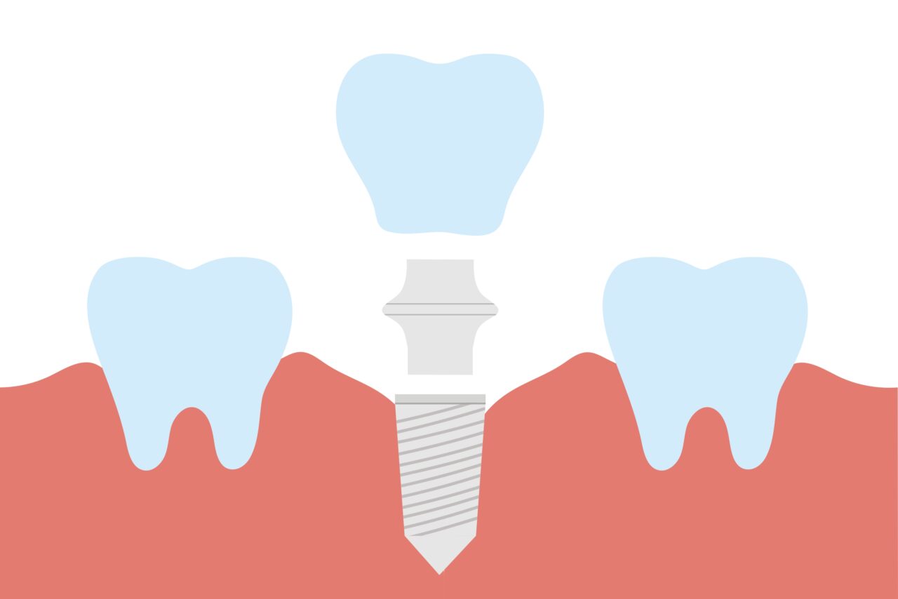 インプラントとは？メリット・デメリットや治療の流れ