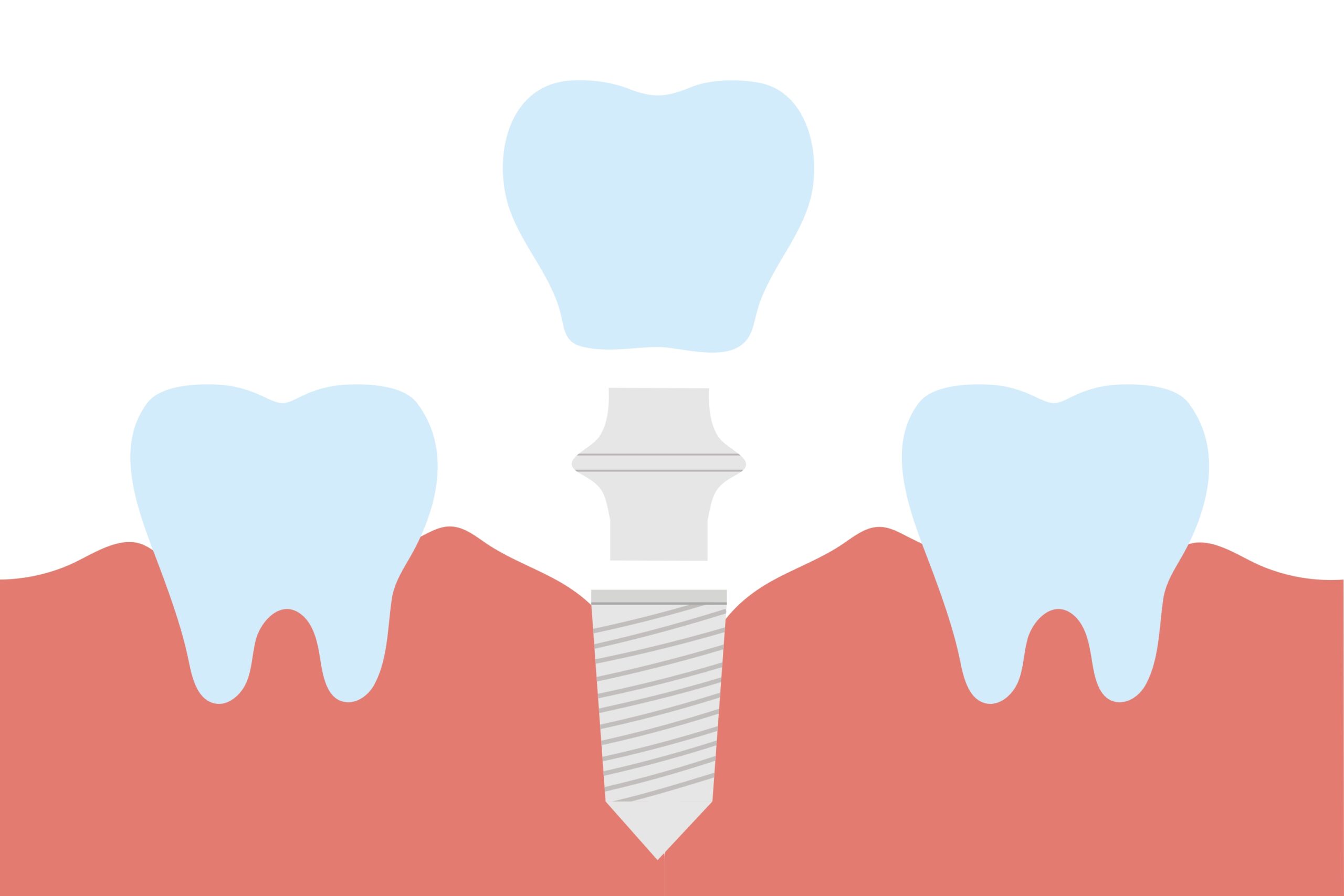 インプラントとは？メリット・デメリットや治療の流れ