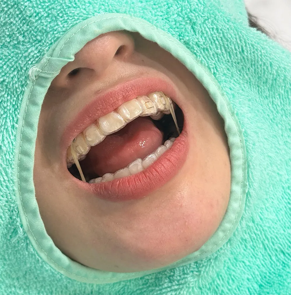 顎間ゴムを使用したとき