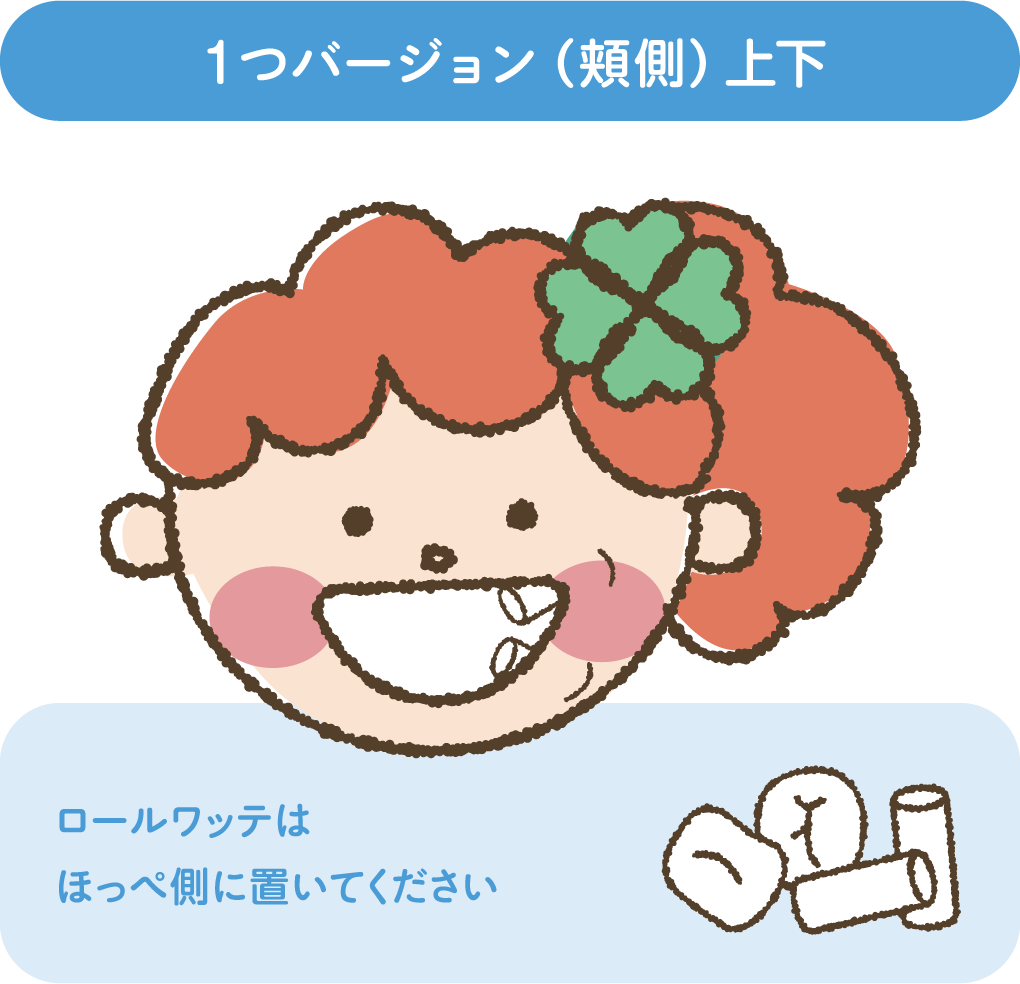 1つバージョン（頬側）上下