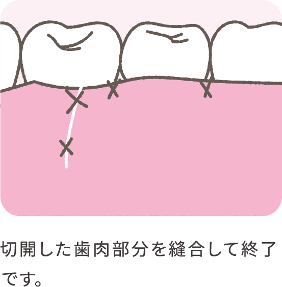 emdogain-04_pc@2x-min