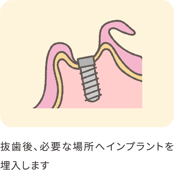 implant-GTR-02_pc@2x-min