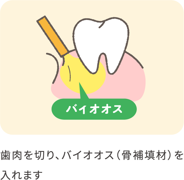 implant-GTR-03_pc@2x-min
