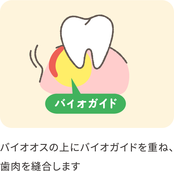 implant-GTR-04_pc@2x-min