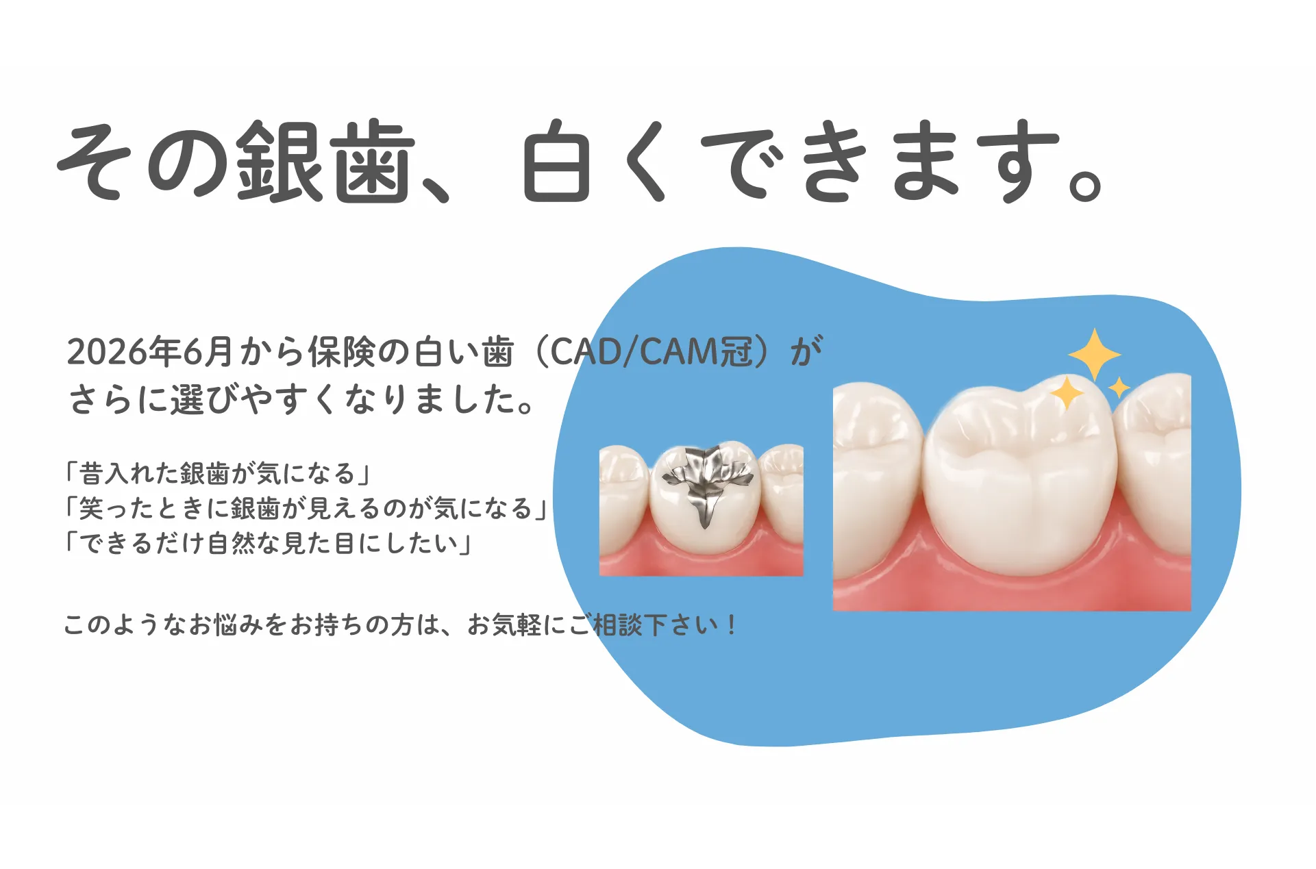 その銀歯、白くできます。